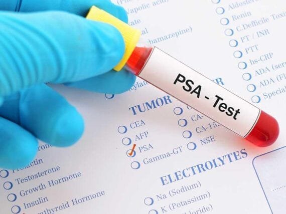 Prostate-Specific Antigen Test
