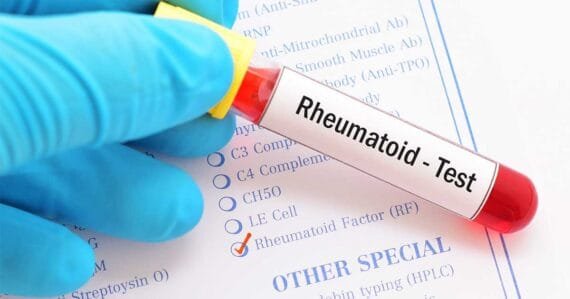 rheumatoid-factor-test